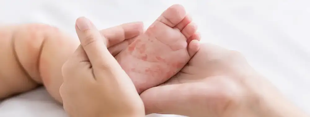 Picture of a woman holding the foot of a young baby and the foot has discoloration